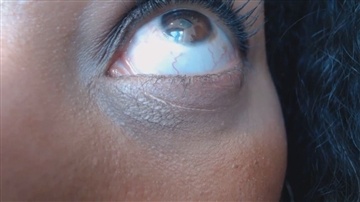 GoldenLace - Hyperactive Bloodshot Eye Closeup